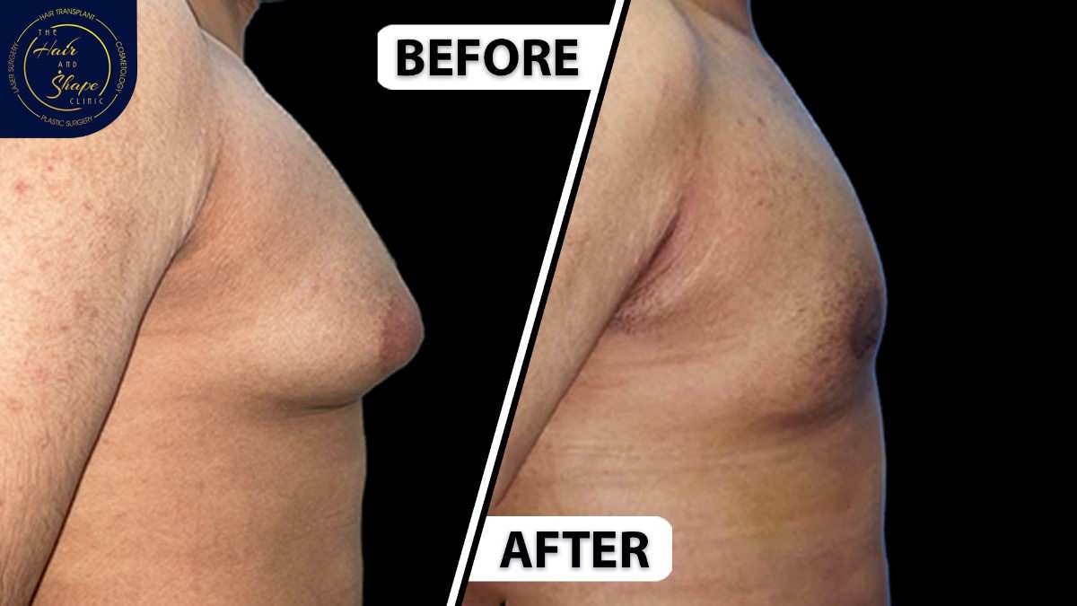 Gynecomastia result9